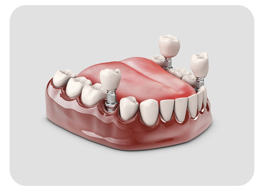 「天然歯のような感覚で噛める」口腔環境を提供しています