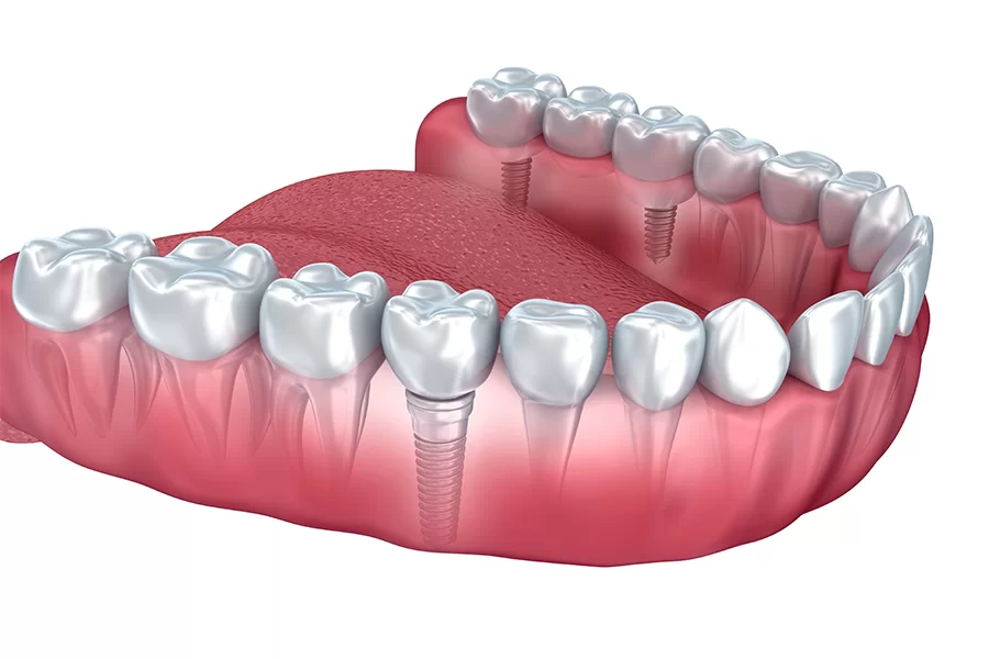 顎の骨の状態や神経の位置を詳細に把握しながら治療計画を立てています