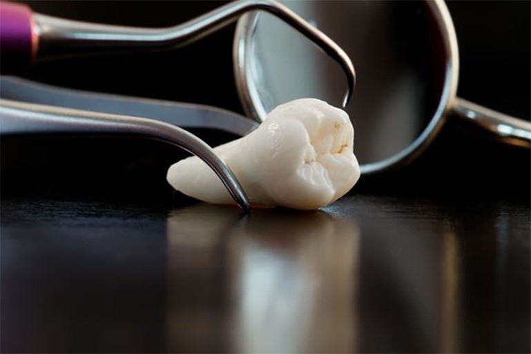 親知らずの抜歯においても患者様の不安に寄り添い、納得して治療を受けていただけるよう段階ごとの説明と丁寧な処置を大切にしています。