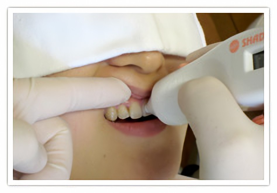 ホワイトニング用測定器のシェードアップナビ