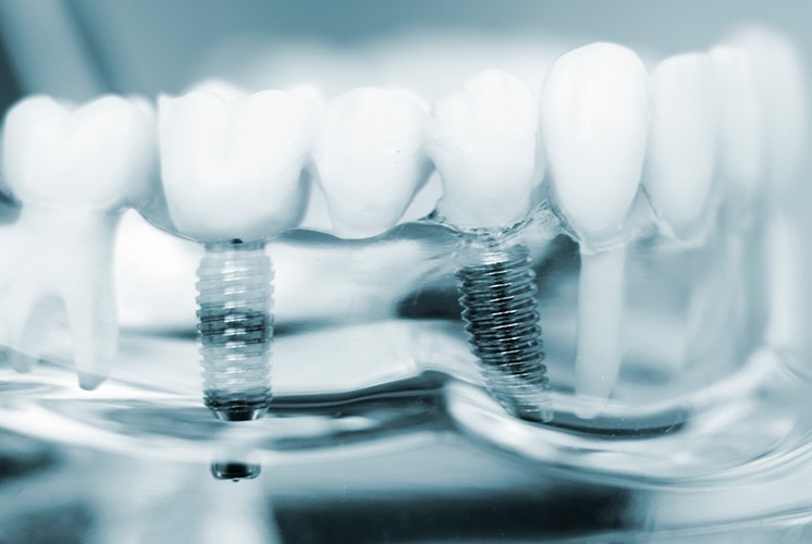 院長は大口式インプラント専門医として豊富な経験を有しています