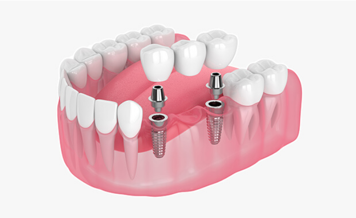 インプラント治療のメリット・デメリットなどご不明な点はお気軽にご相談ください。