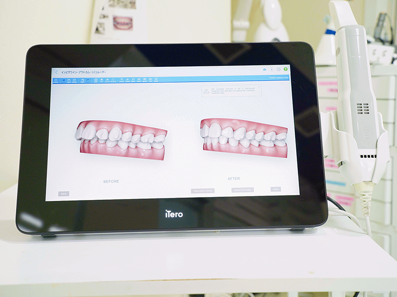 口腔内スキャナーによりスキャニングを行い精密な歯型を製作します