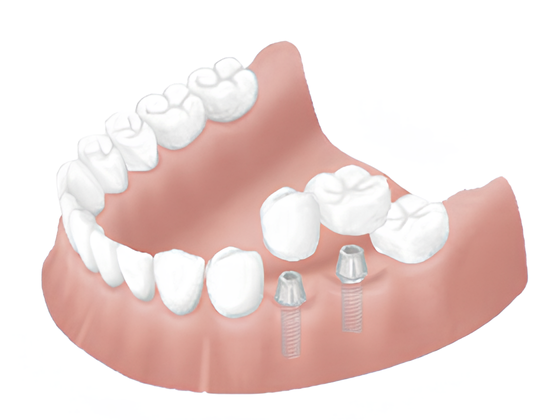 法人全体として9年間で1000本以上のインプラント治療に携わってきた実績があり、豊富な経験を積み重ねています。