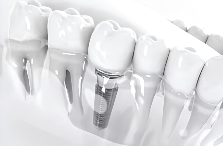 お子様から大人まで安心のインプラント治療