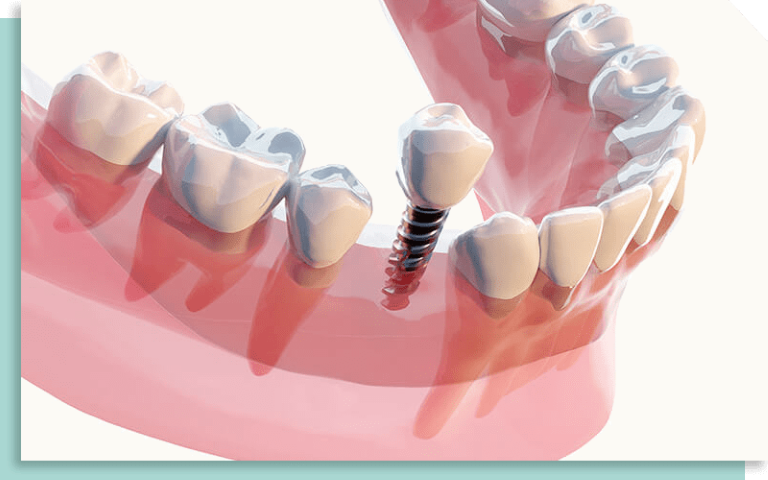 骨や咬合まで考え抜いた高精度な補綴