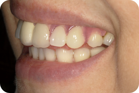 ノンクラスプデンチャー