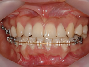 見た目を気にされる方や、接客業・営業職など人前に出る機会の多い方に特に支持されている治療法です。