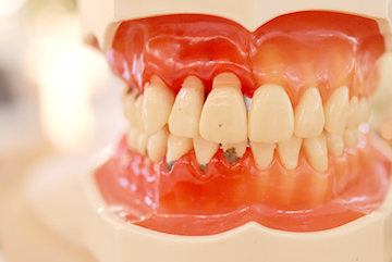 歯周病は早期発見・早期治療が鍵です