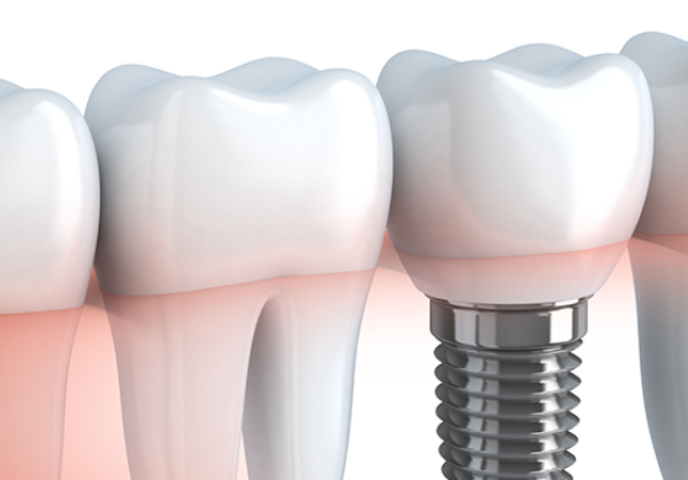 快適な食生活を実現、柏木歯科医院のインプラント治療