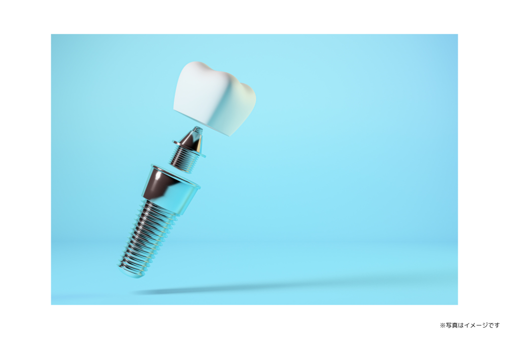 入れ歯のような違和感はなく、ブリッジのように周囲の健康な歯に負担をかけることもありません