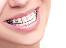 「クリアライナー」を使用した矯正治療を提供しています