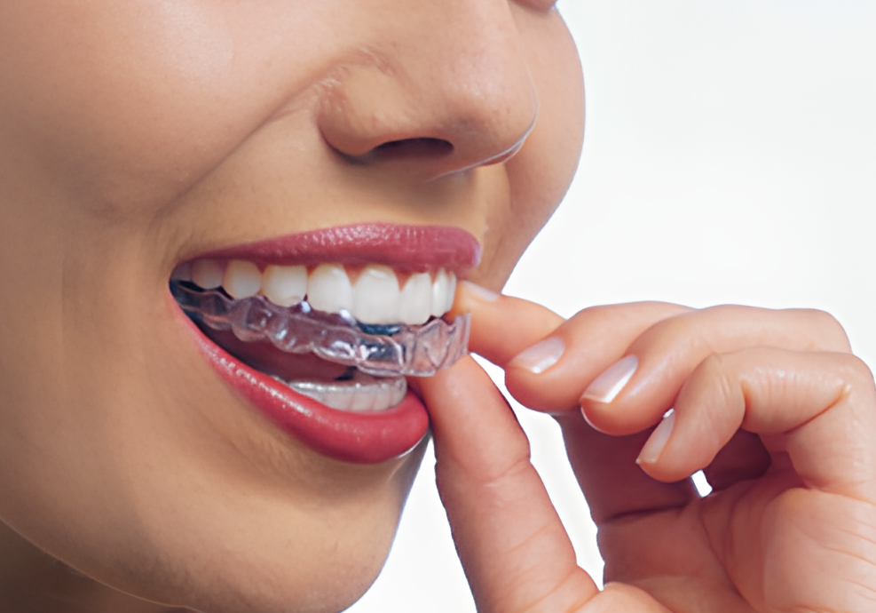 透明マウスピースで快適かつ審美的な歯列矯正を提供