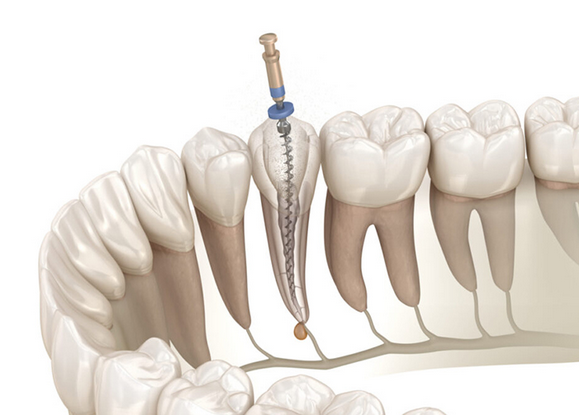 高倍率歯科用ルーペを使用した精密な根管治療