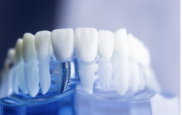 全ての歯を失った場合にも対応できるのがインプラントの強みです