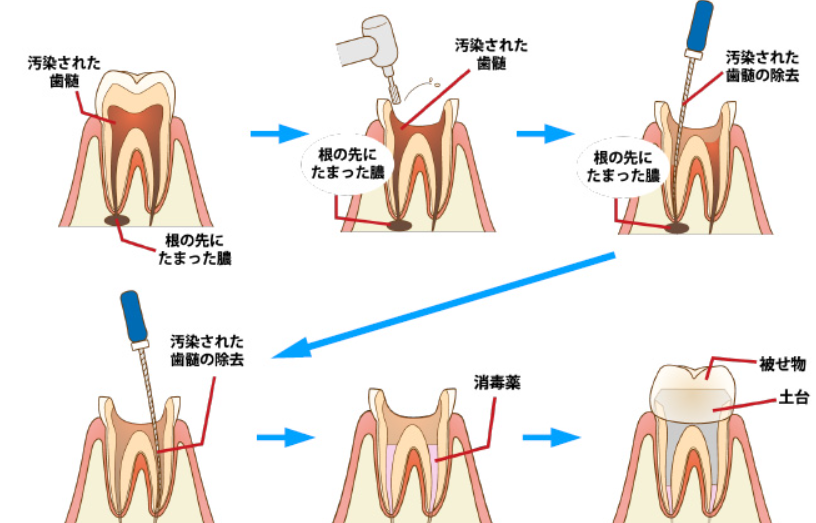 根管治療の手順