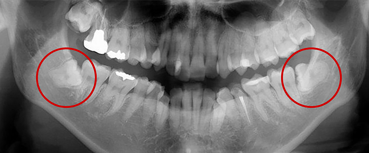 歯茎に埋まっている親知らずも要注意
