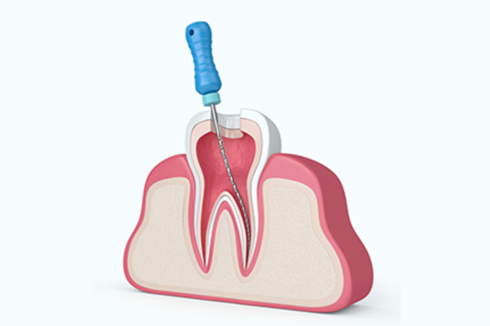 最新機器と確かな技術で、歯を残すための治療を提供