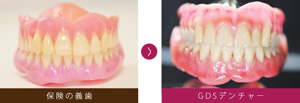 噛みやすさと装着感を考えた入れ歯治療を行っています