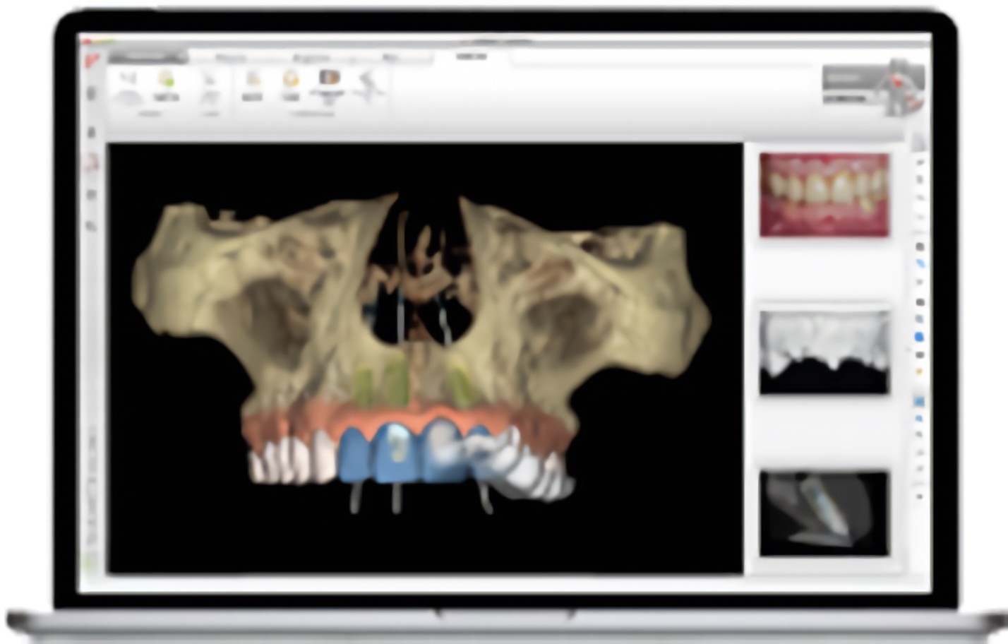 ノーベルガイドシステムを導入