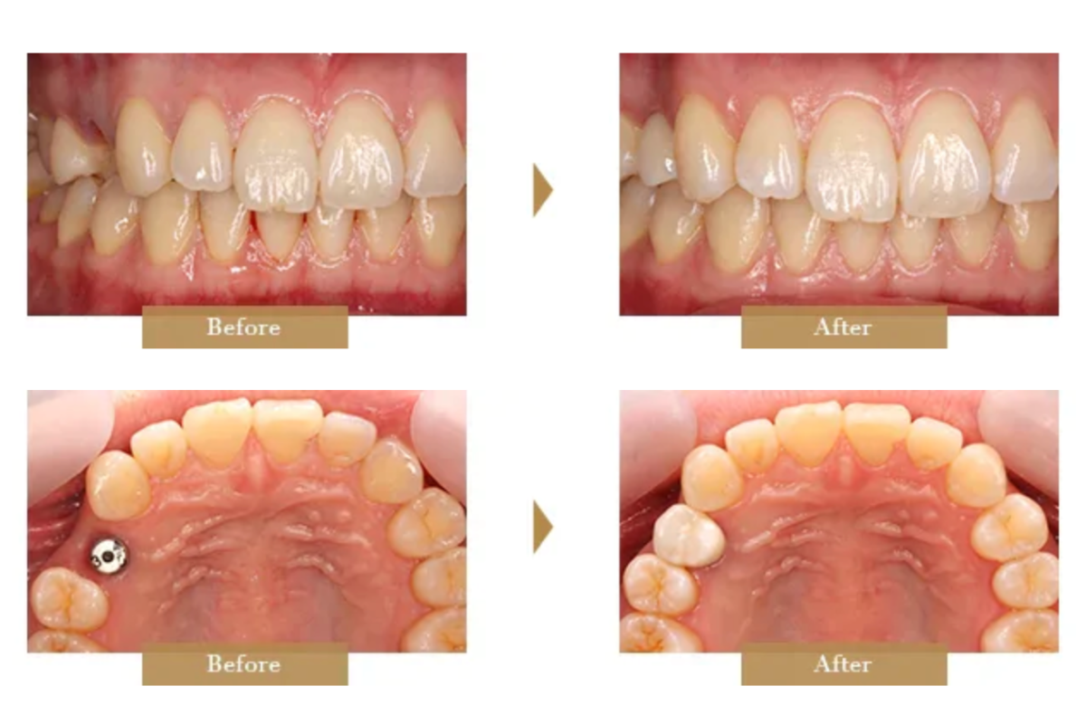 インプラント治療
