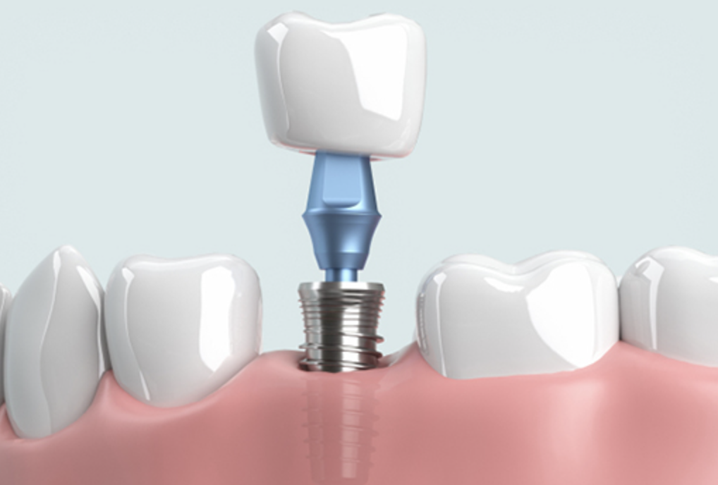 入れ歯やブリッジに抵抗がある患者様に対して、インプラントをご提案しています