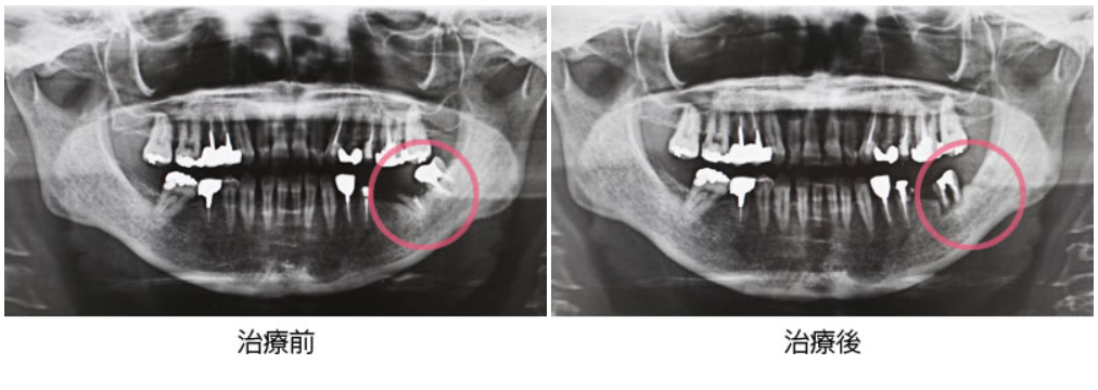 自家歯牙移植の治療例写真