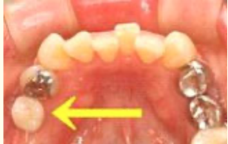 機能性と審美性に優れたインプラント治療を提供します
