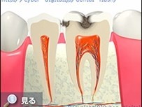 日々の歯磨きを怠ったり、汚れが溜まりやすく磨きにくい部位から徐々に進行していきます