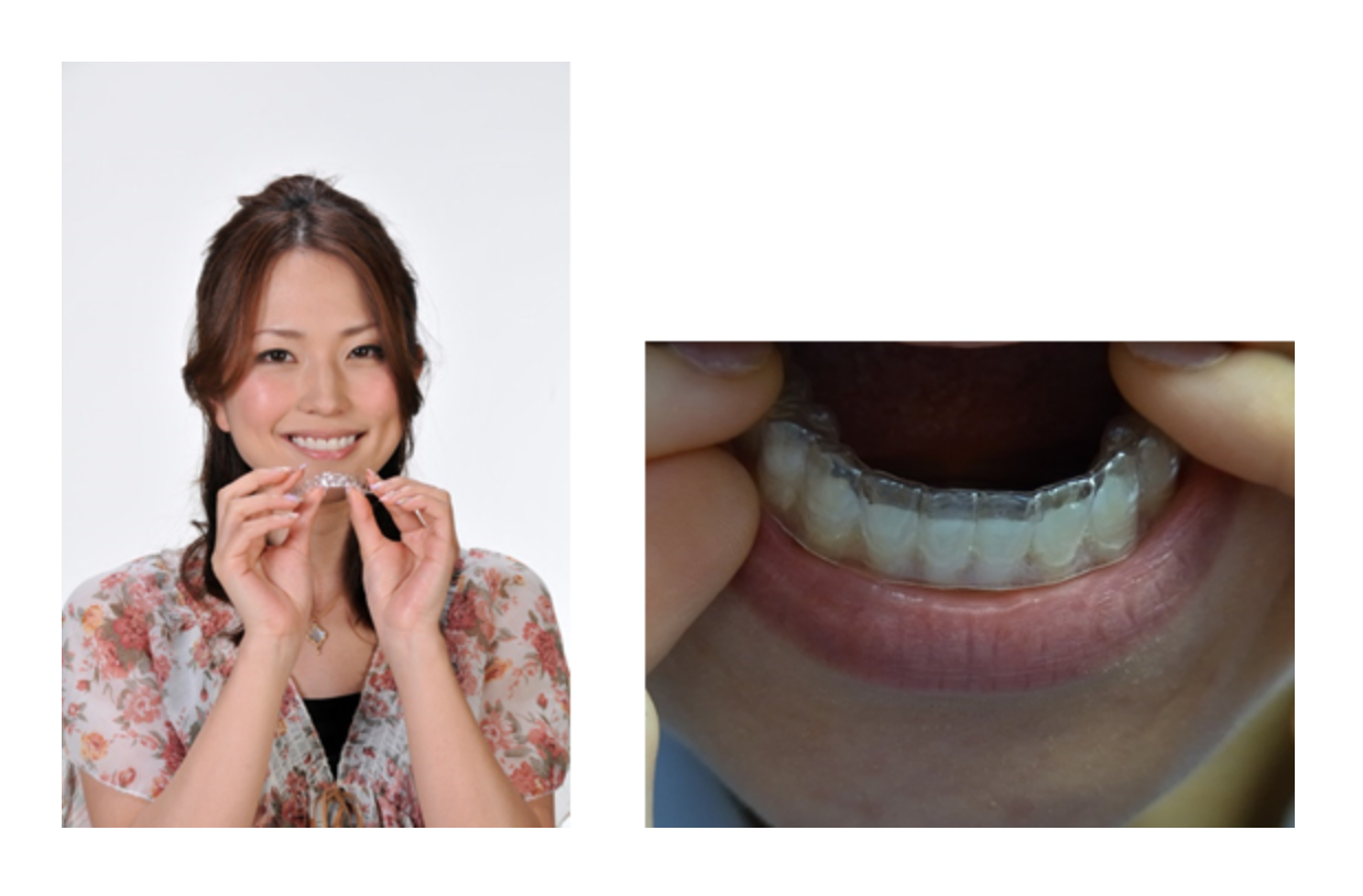 矯正治療を行うことで、歯の機能を改善し、口腔内の健康を維持しやすくなります