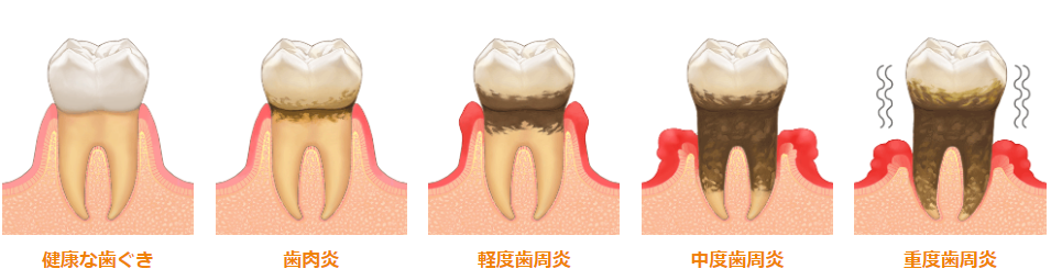 専門医による歯周病治療と予防