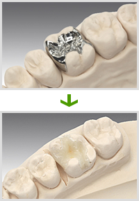 銀歯などが目立たないセラミック素材を使用しています