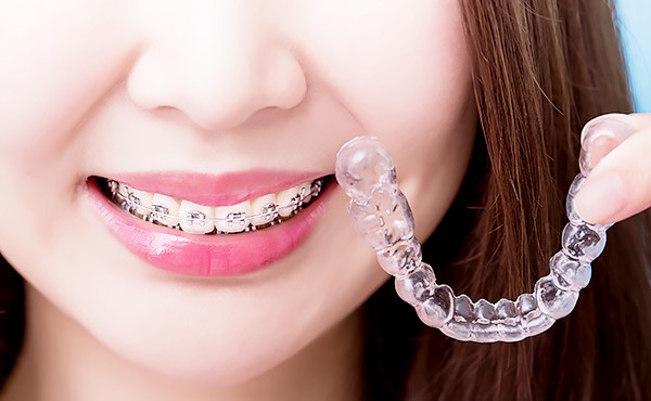 透明なマウスピース型の矯正装置もございます