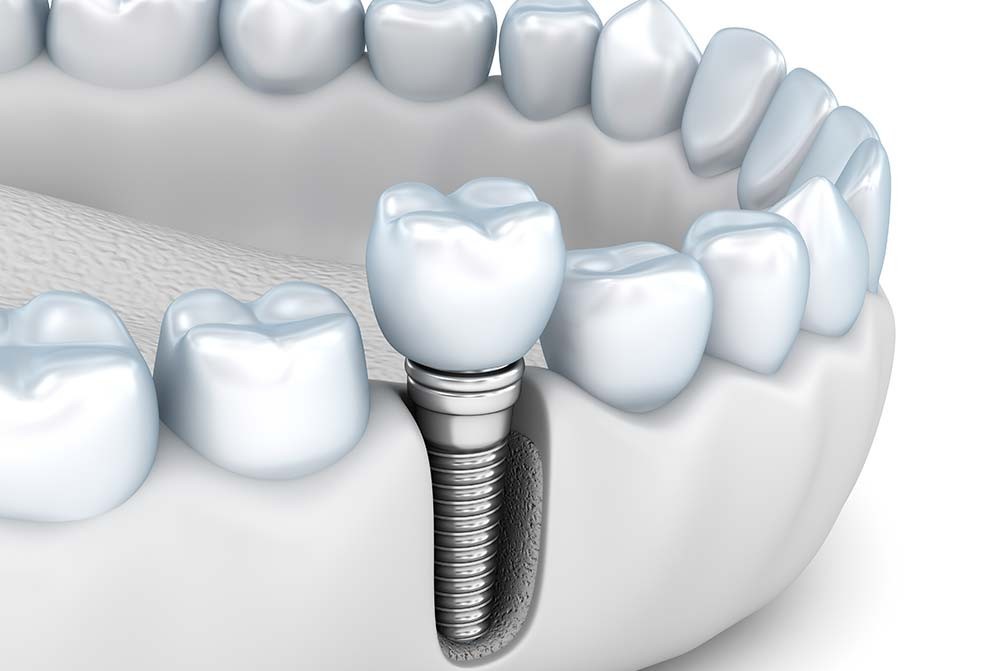 インプラントを専門的に行う歯科医師が治療を担当しています