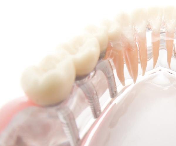 精密な診断と安全性に配慮したインプラント治療を提供します
