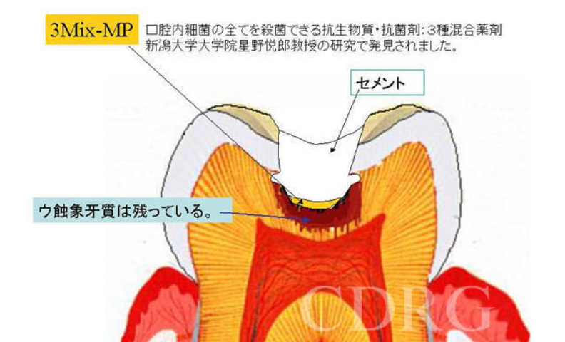 3Mix-MP®療法のイメージ