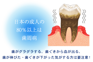 日本では成人の約80％が歯周病にかかっているとされ、決して特別な病気ではありません