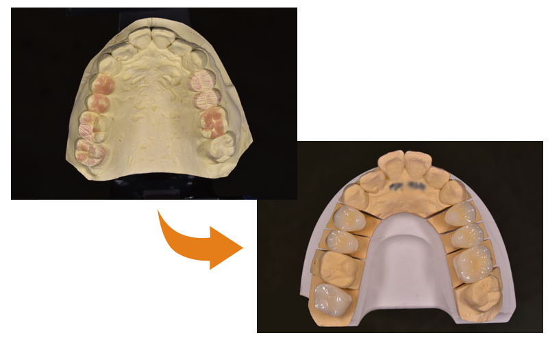 審美的に優れた補綴物をご用意しています