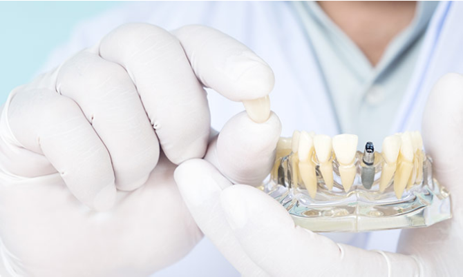 インプラントは、見た目が自然で仕上がりが綺麗&違和感なく&しっかり噛める