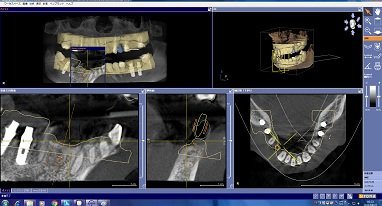 インプラント治療を20年行ってきた経験と実績があります