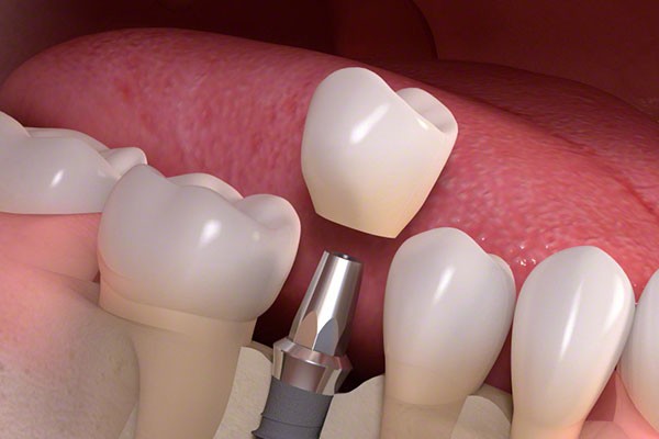 天然歯に近い噛み心地を目指す安心の選択