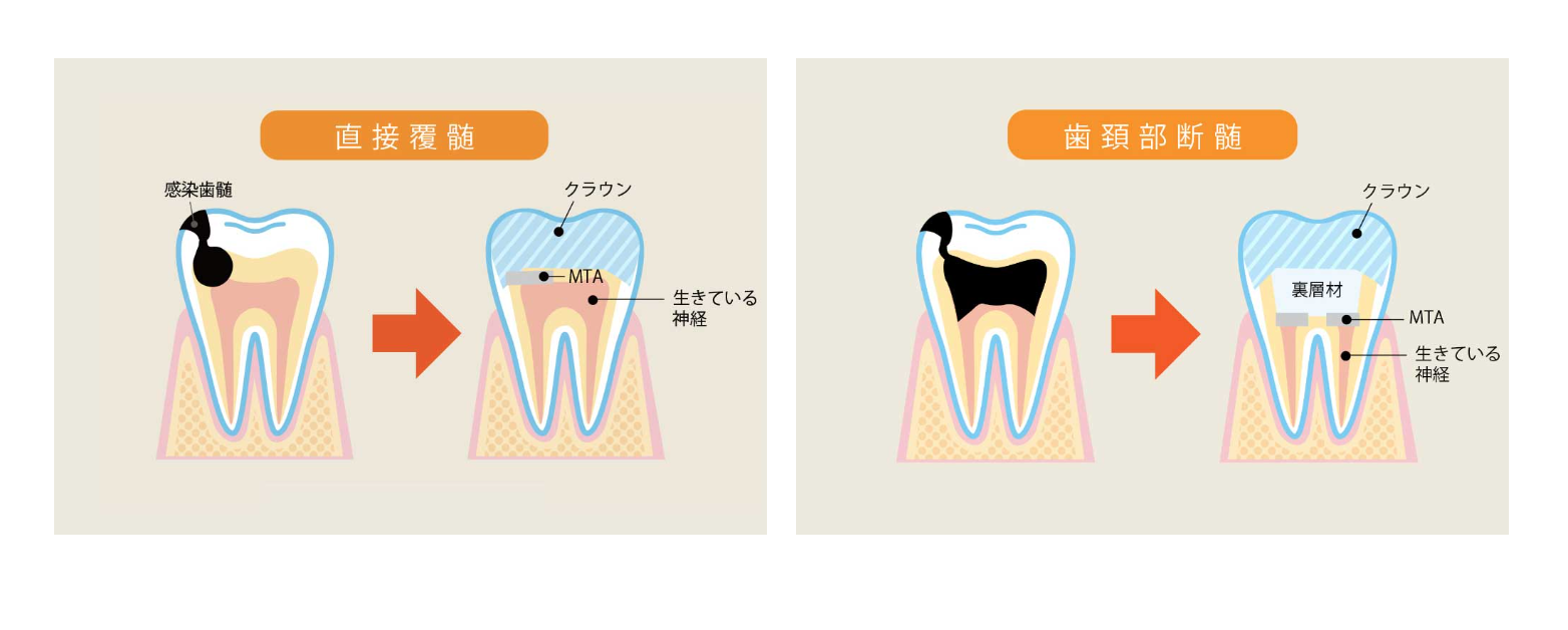 できる限り歯を残すことを大切にし、精密な根管治療を行っています