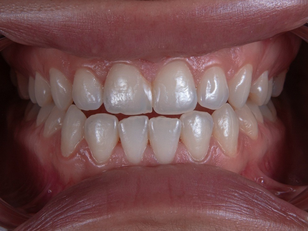 銀歯や歯の黄ばみが気になる方には審美治療がおすすめです