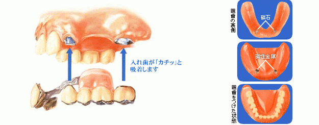 マグネットデンチャーのイメージ