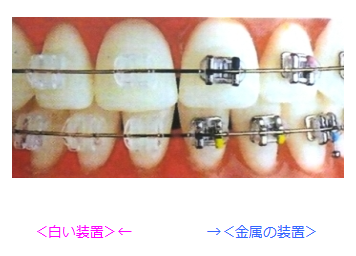 白い矯正装置もあります