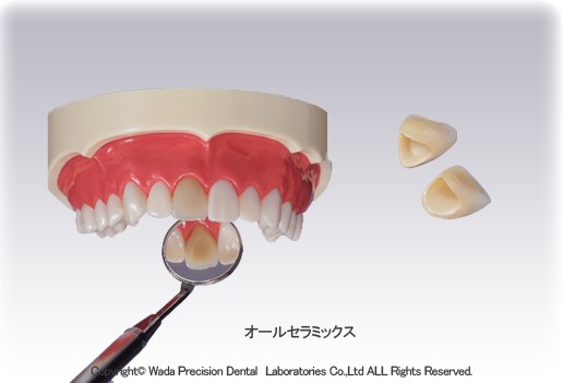 オールセラミックス