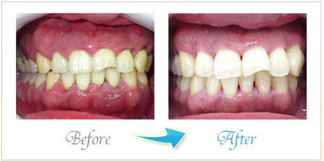 歯周ポケットに詰まっている歯石も除去できます