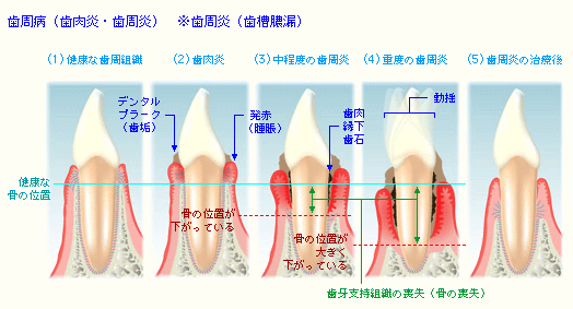 歯周病の進行度合について