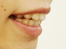 ホワイトニング