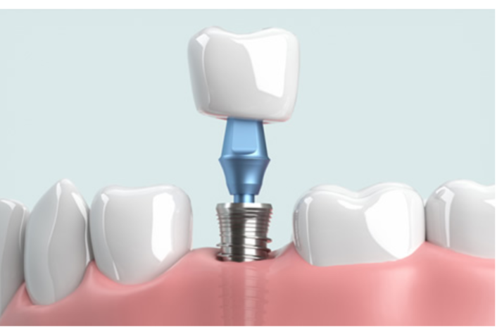 インプラントの図